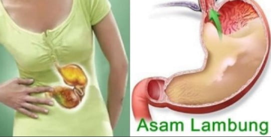 Waspadai Asam Lambung dengan Mempelajari Gejalanya