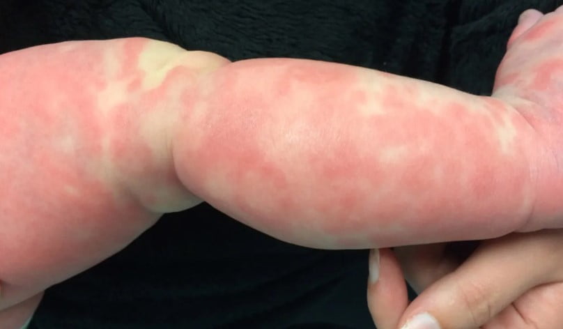 mengenal dan menangani serum sickness. (ist) mengenal dan menangani serum sickness. (ist)