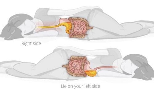 10 cara mengatasi asam lambung tanpa obat secara alami dan cepat