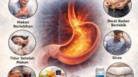 cara mengatasi asam lambung naik tanpa obat berlebihan