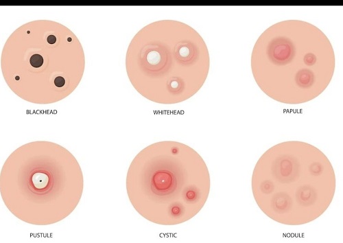 jerawat penyebab, cara menghilangkan, dan rahasia kulit bersih tanpa ribet