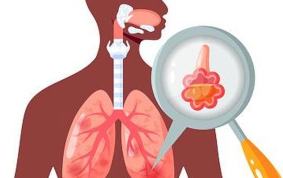 Tanda Infeksi Paru-Paru yang Sering Diabaikan, Waspada Sebelum Parah