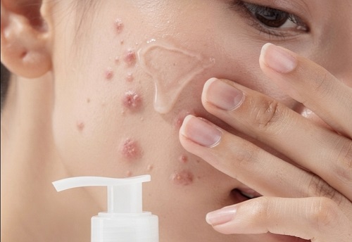 moisturizer untuk jerawat terbaik 2026 nggak bikin mampet, nggak perih, tenangin merah + resep jus tomat wortel anti inflamasi buat kulit calm
