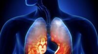 radang paru paru (pneumonia) penyebab, gejala, dan cara mengatasinya secara tepat