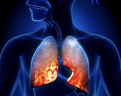 radang paru paru (pneumonia) penyebab, gejala, dan cara mengatasinya secara tepat